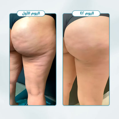 مجموعة ويلنس™ لعلاج السيلوليت